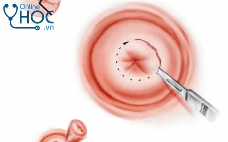 Bệnh Loạn sản cổ tử cung: Nguyên nhân, triệu chứng, chẩn đoán, cách điều trị và phòng ngừa