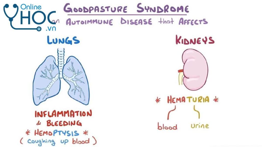 Hội chứng Goodpasture: Nguyên nhân, triệu chứng, chẩn đoán, cách điều trị và phòng ngừa