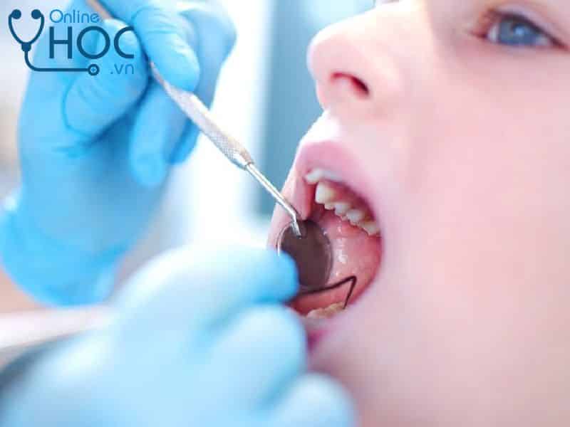 Bệnh Sâu răng: Nguyên nhân, triệu chứng, chẩn đoán, cách điều trị và phòng ngừa