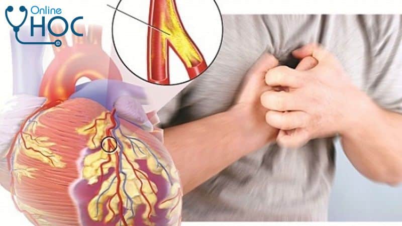 Bệnh Xơ vữa động mạch: Nguyên nhân, triệu chứng, chẩn đoán, cách điều trị và phòng ngừa