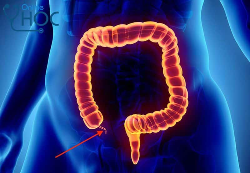 Bệnh viêm ruột thừa: Nguyên nhân, triệu chứng, chẩn đoán, cách điều trị và phòng ngừa