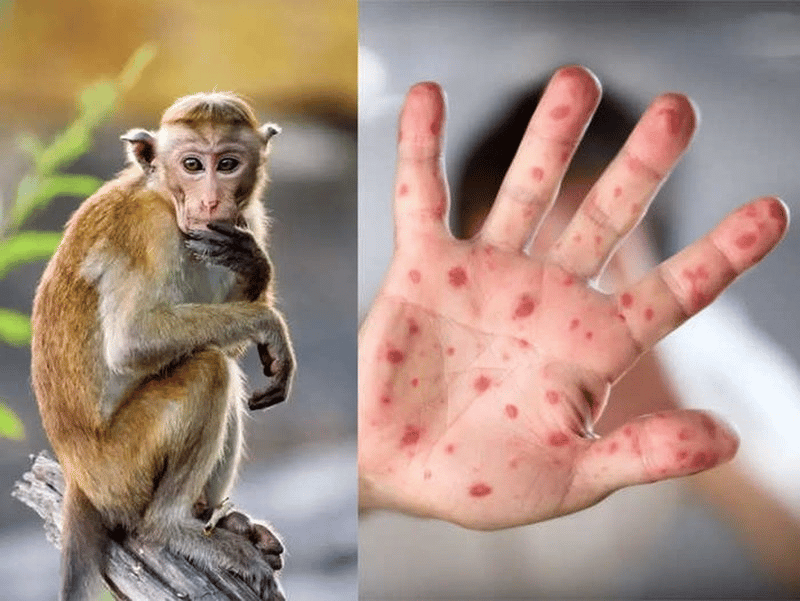 Việt Nam trước nguy cơ cao đối diện với bệnh đậu mùa khỉ xâm nhập, triệu chứng và cách điều trị bệnh